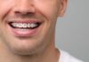 Gerade Zähne in Zürich beginnen mit der richtigen Beratung: Was Patienten vor einer Zahnkorrektur wissen sollten 